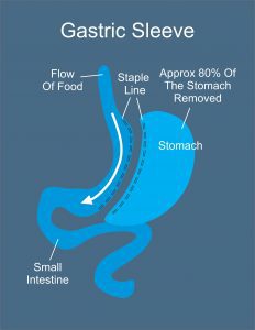 Gastric-Sleeve_New-Anatomy-Image (1)