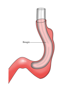 bougie gastric sleeve