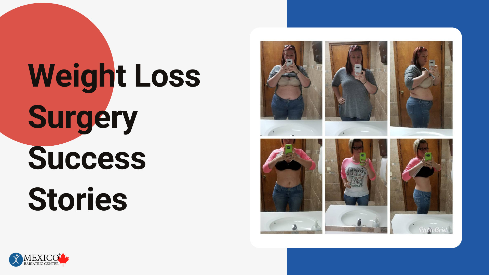 Weight Loss Surgery Success Stories and Transformations Mexico